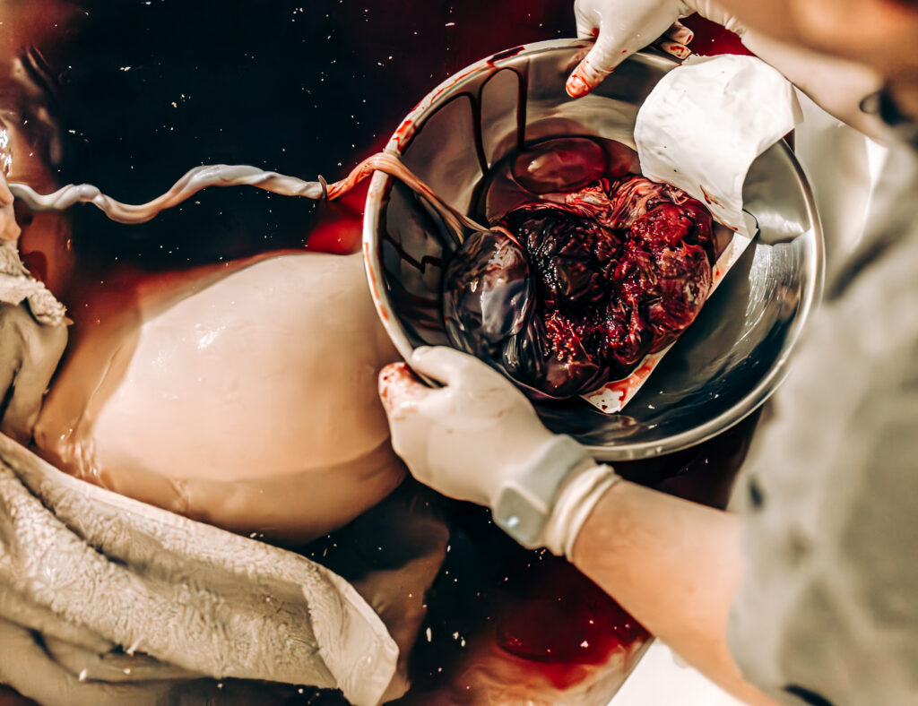 placenta still attached via umbilical cord sits in a bowl floating in a birth tub 